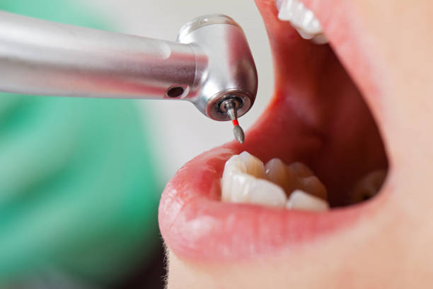 Best Emergency Root Canal Treatment in Yates Center, KS